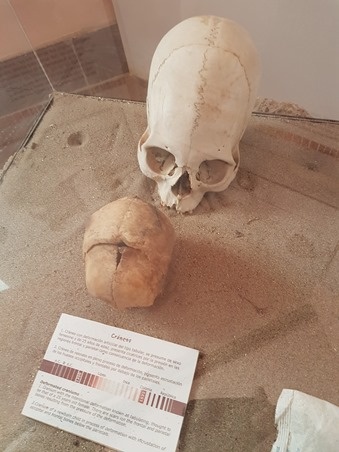 The deformed cranium of an Incan noble